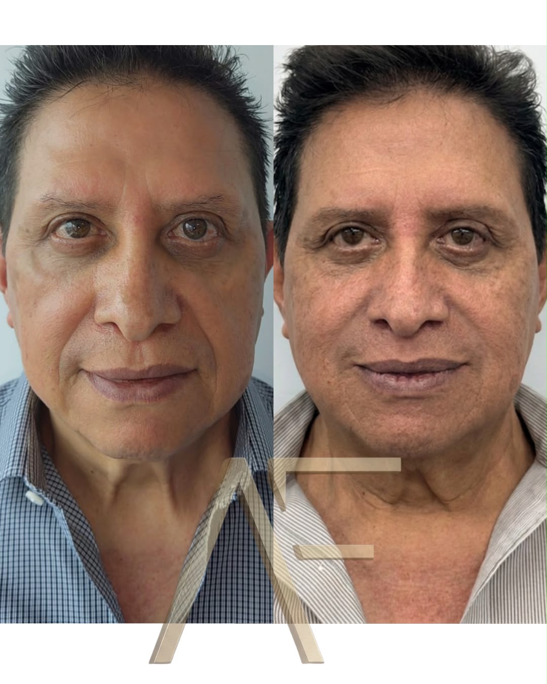 Comparativa clínica de antes y después con bioestimuladores de colágeno