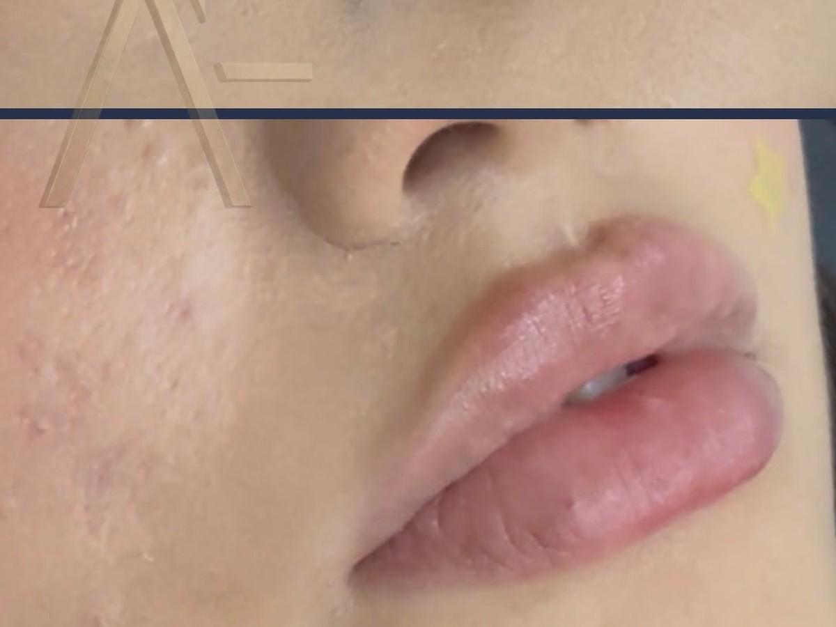 Cuidados después del relleno de labios con ácido hialurónico — guía informativa de cuidados posteriores