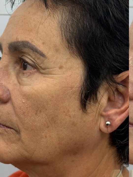 Perfil y contorno — Antes