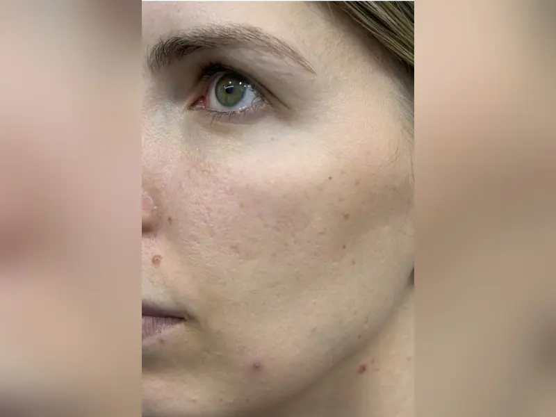 PDRN + Exosomas — tratamiento de medicina estética en CDMX