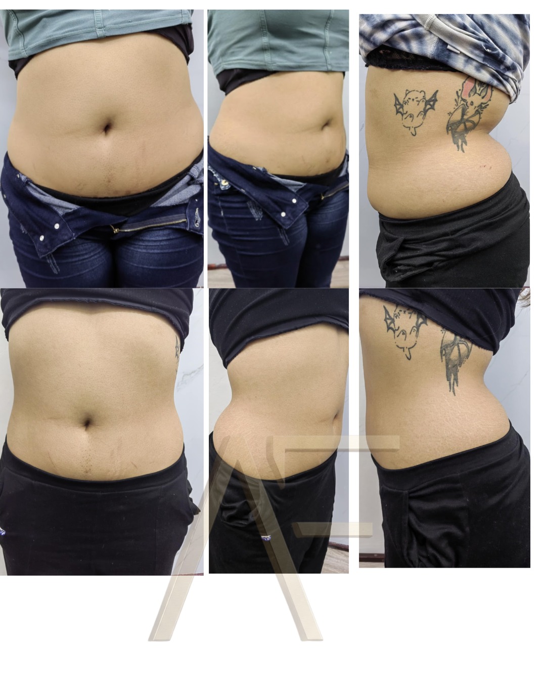 Comparativa clínica de Enzimas Recombinantes en abdomen