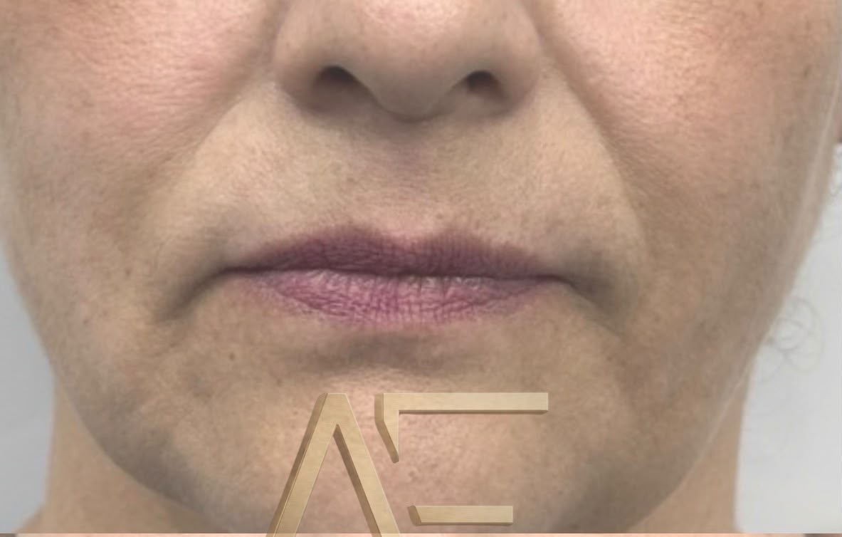 Definición de borde labial — Antes