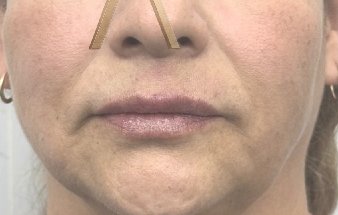 Definición de borde labial — Después